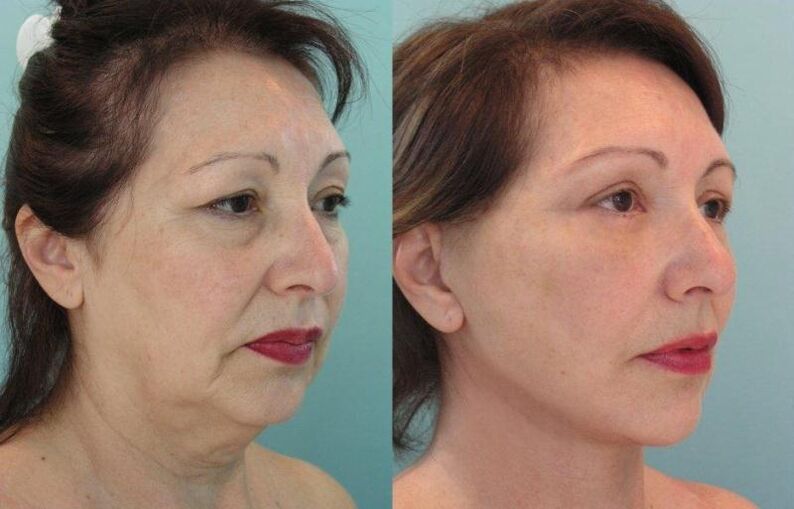 Ang resulta ng rejuvenating facial skin tightening na may mga thread
