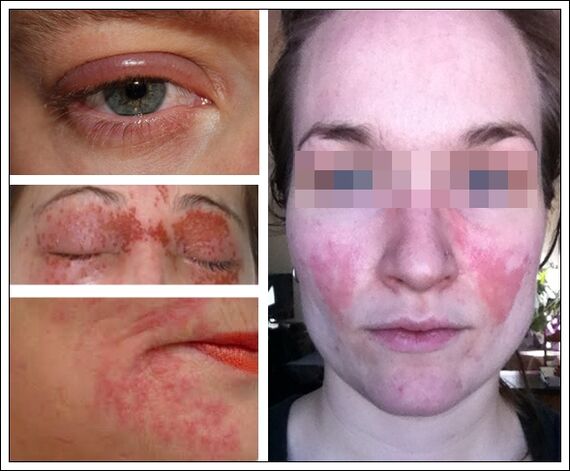 allergy sa mga anti-aging mask